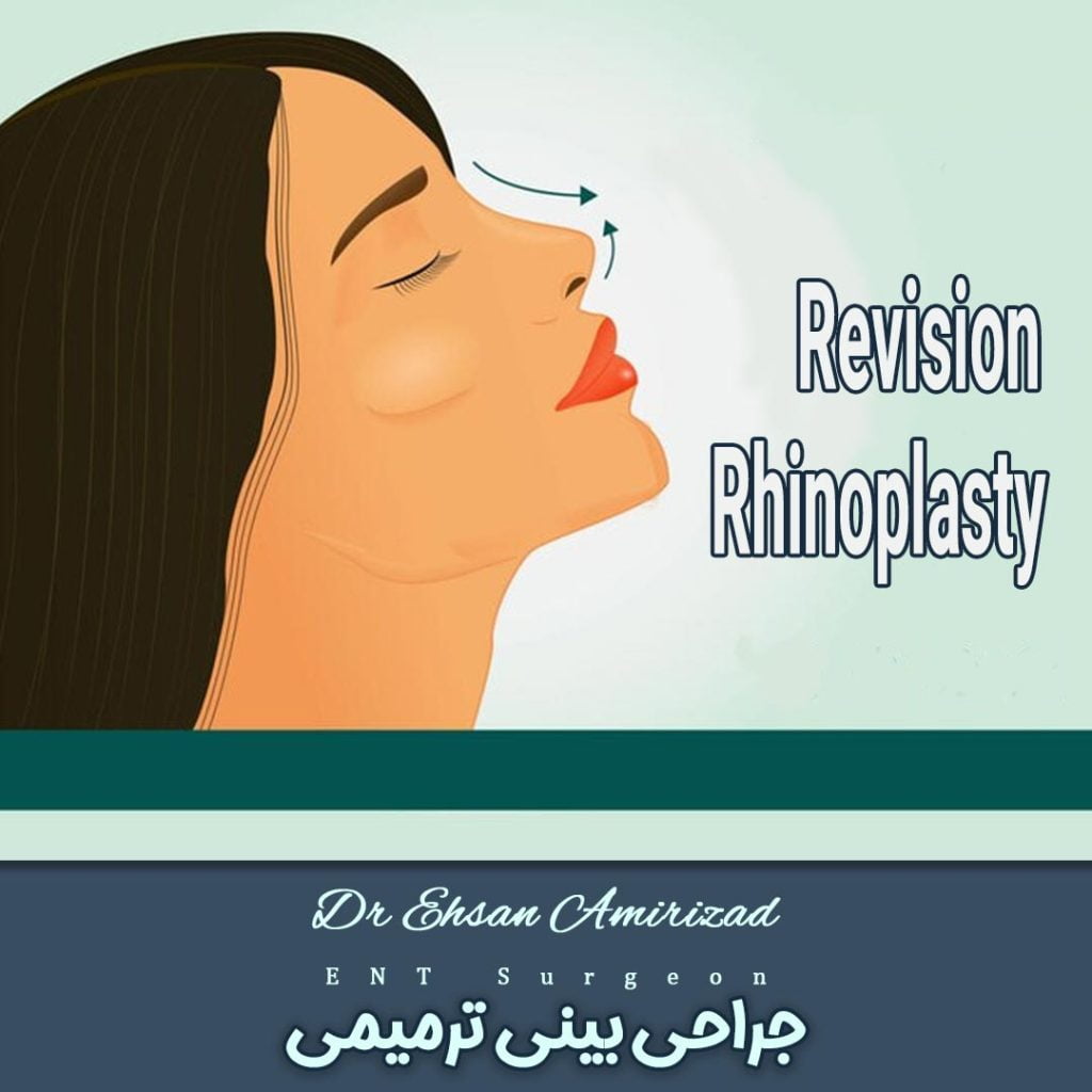جراحی بینی ترمیمی - دکتر احسان امیری زاد
