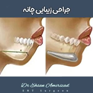 جراحی پروتز چانه ، دکتر امیری زاد در تهران