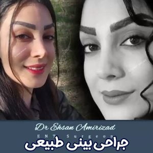 جراحی بینی طبیعی + دکتر احسان امیری زاد