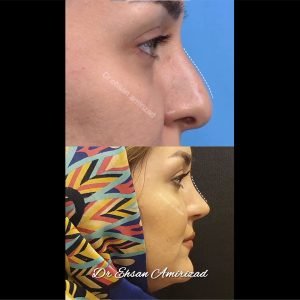 نمونه کار جراحی بینی طبیعی دکتر امیری زاد
