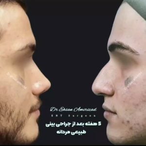 نمونه کار جراحی بینی طبیعی دکتر امیری زاد