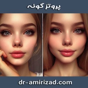 پروتز گونه از دکتر احسان امیری زاد ، بهترین جراح بینی و پلاستیک تهران