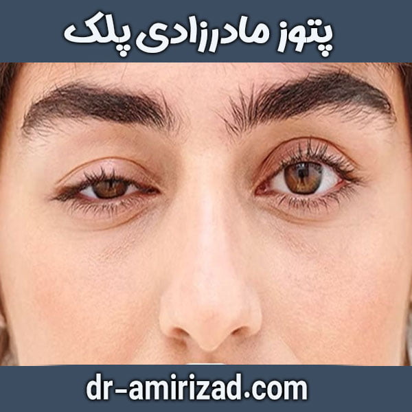 اصلاح پتوز مادرزادی پلک توسط دکتر امیری زاد در تهران