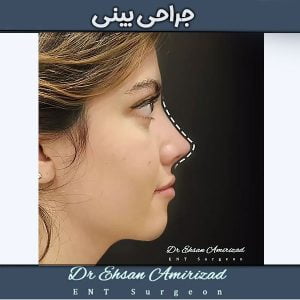 جراحی بینی دکتر امیری زاد در تهران