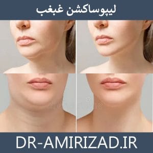 لیپوساکشن غبغب | دکتر امیری زاد