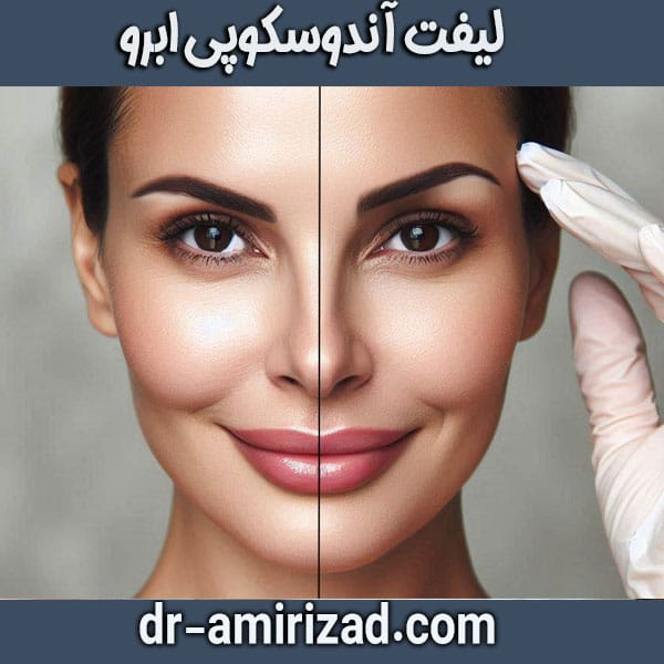 لیفت آندوسکوپی ابرو از دکتر احسان امیری زاد ، بهترین دکتر زیبایی در تهران