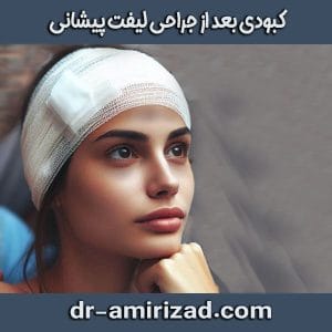 کبودی بعد از لیفت پیشانی ، از دکتر احسان امیری زاد ، بهترین جراح لیفت پیشانی تهران