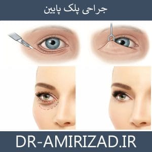 جراحی پلک پایین | دکتر امیری زاد
