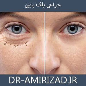 جراحی پلک پایین | دکتر امیری زاد
