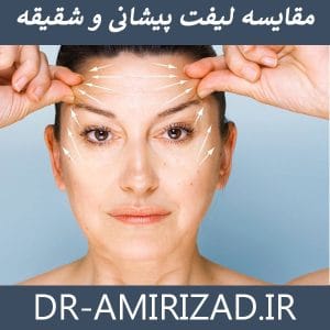 مقایسه لیفت پیشانی و شقیقه | دکتر احسان امیری زاد