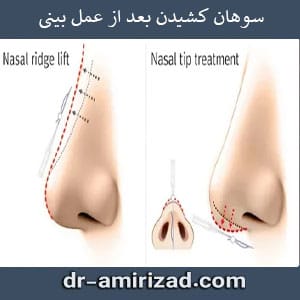 سوهان کشیدن بعد از جراحی بینی | دکتر امیری زاد