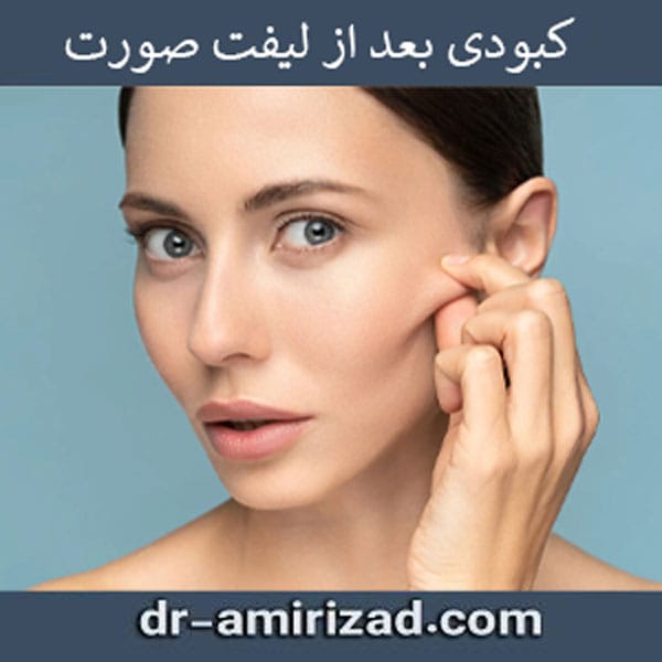 کبودی بعد از جراحی لیفت صورت - دکتر امیری زاد