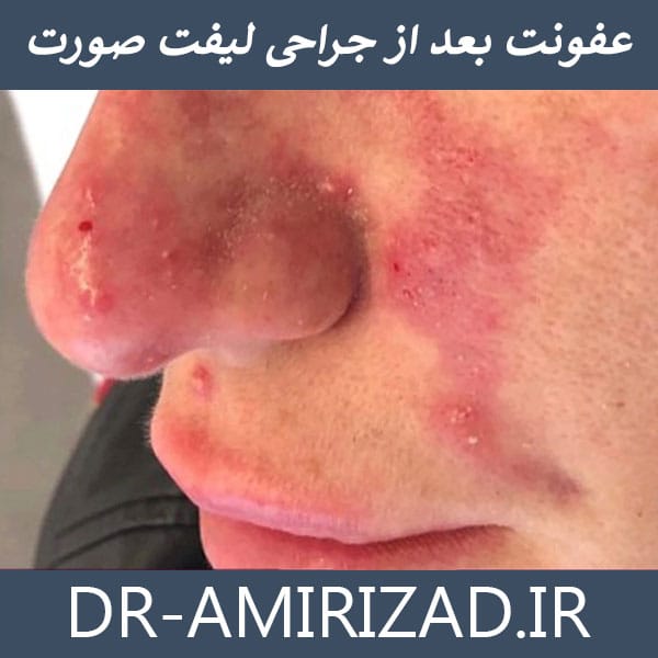 عفونت بعد از جراحی لیفت صورت