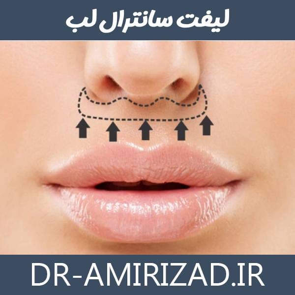 لیفت سانترال لب