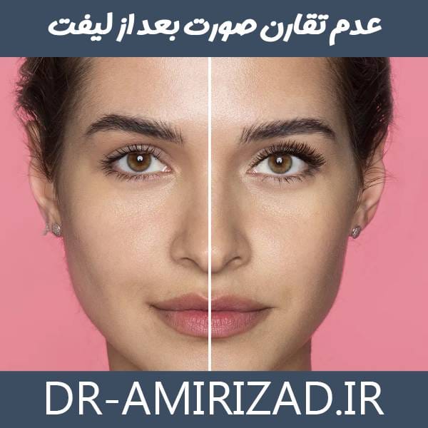 عدم تقارن صورت بعد از لیفت 
