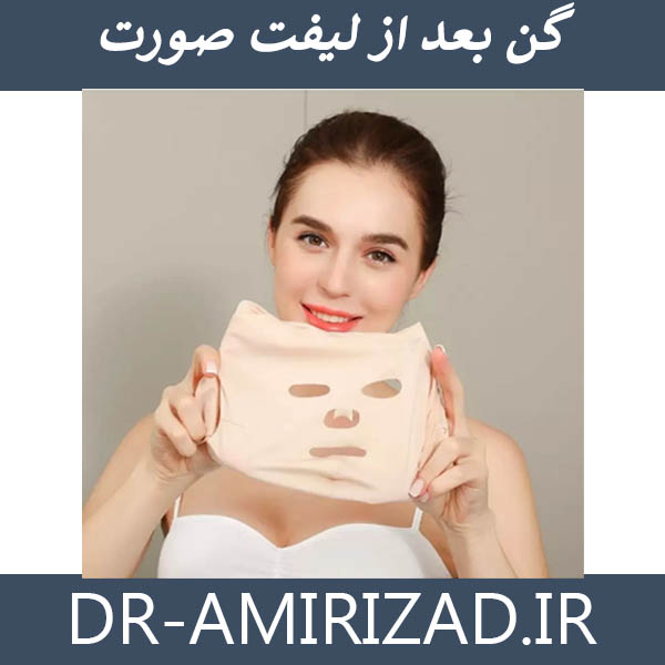 گن بعد از لیفت صورت